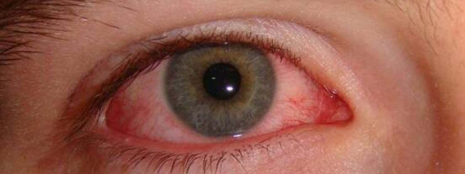 Eye disease spreading in Sri Lanka